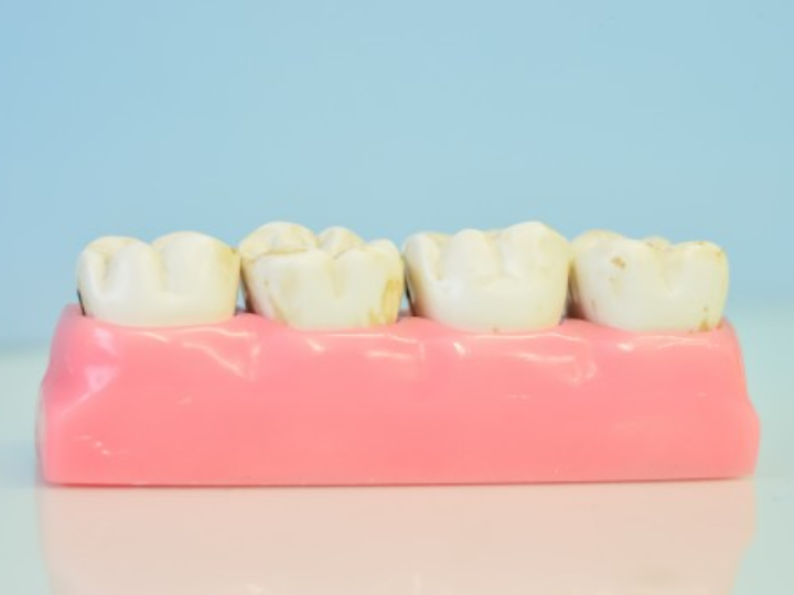 como se comporta un implante dental una vez puesto